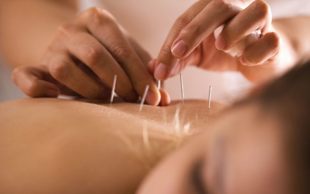Does Acupuncture for Fertility Work?